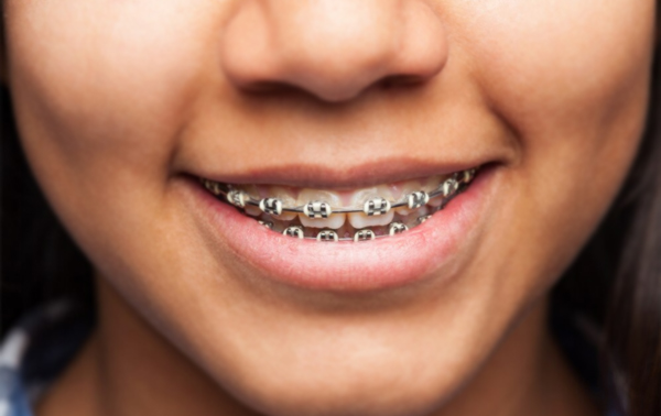 Metal and Conventional Braces