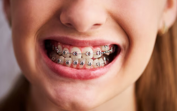 Invisible Braces and Lingual Braces