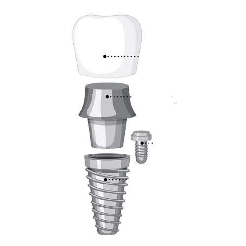 Dental Implant